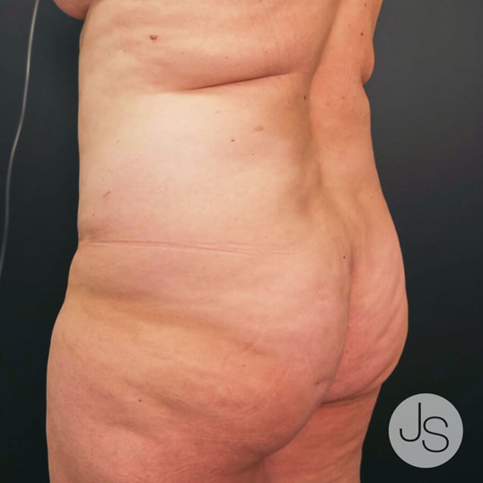 Liposuction (Smooth Lipo) Before and After Pictures Beverly Hills, CA