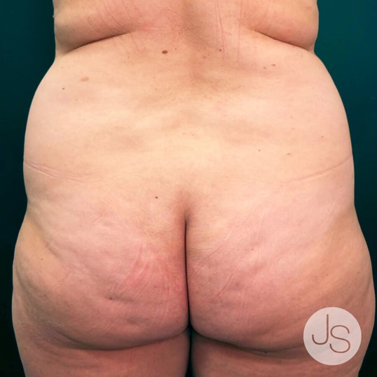 After Weight Loss Surgery Before and After Pictures Beverly Hills, CA