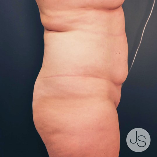 Liposuction (Smooth Lipo) Before and After Pictures Beverly Hills, CA