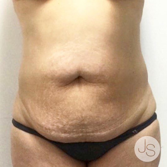 Tummy Tuck Before and After Pictures Beverly Hills, CA