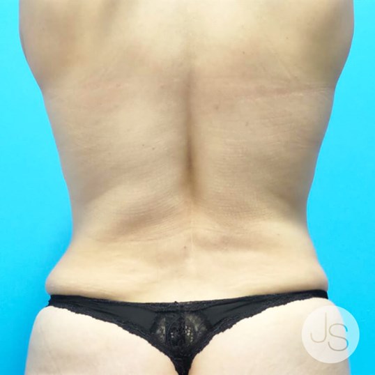 Tummy Tuck Before and After Pictures Beverly Hills, CA