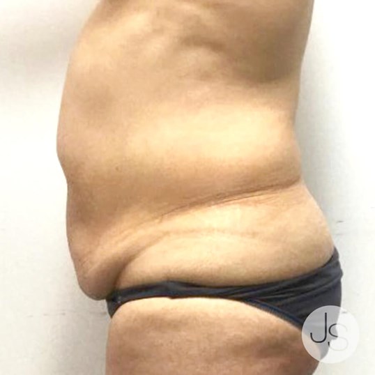 Tummy Tuck Before and After Pictures Beverly Hills, CA