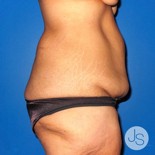 After Weight Loss Surgery Before and After Pictures Beverly Hills, CA