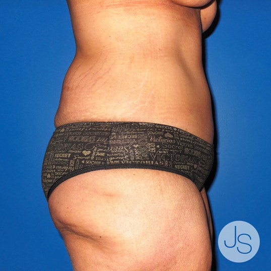 Liposuction (Smooth Lipo) Before and After Pictures Beverly Hills, CA