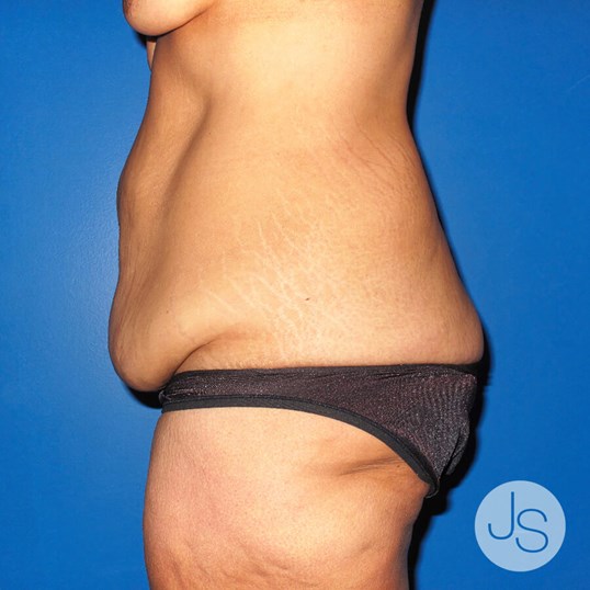 After Weight Loss Surgery Before and After Pictures Beverly Hills, CA