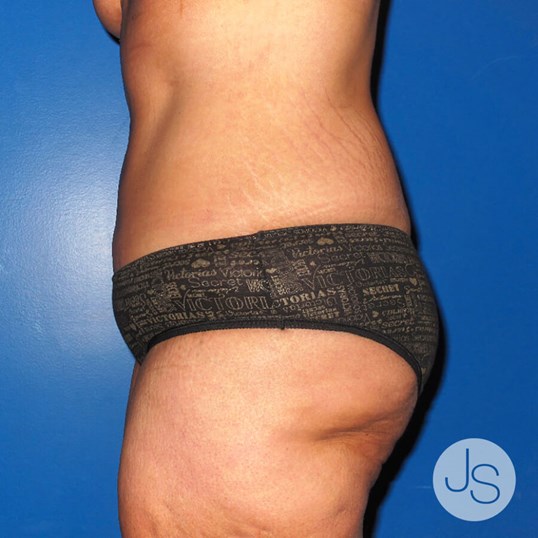 Liposuction (Smooth Lipo) Before and After Pictures Beverly Hills, CA