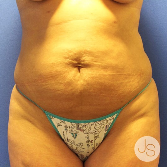 Liposuction (Smooth Lipo) Before and After Pictures Beverly Hills, CA