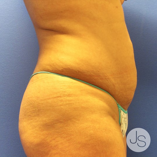 Liposuction (Smooth Lipo) Before and After Pictures Beverly Hills, CA