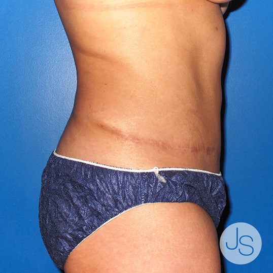 Liposuction (Smooth Lipo) Before and After Pictures Beverly Hills, CA