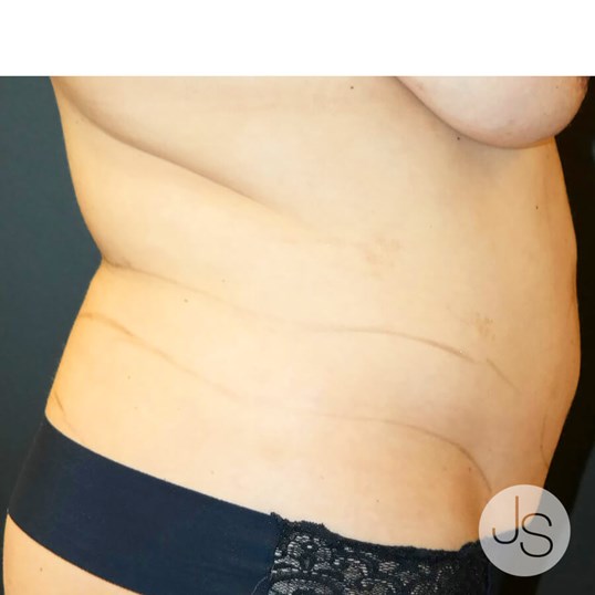 Liposuction (Smooth Lipo) Before and After Pictures Beverly Hills, CA