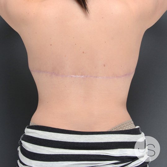 Liposuction (Smooth Lipo) Before and After Pictures Beverly Hills, CA