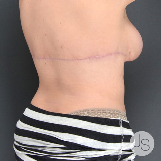 Liposuction (Smooth Lipo) Before and After Pictures Beverly Hills, CA