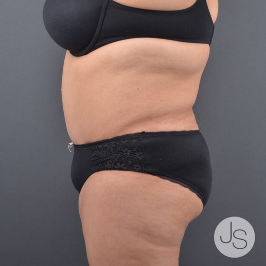 Liposuction (Smooth Lipo) Before and After Pictures Beverly Hills, CA