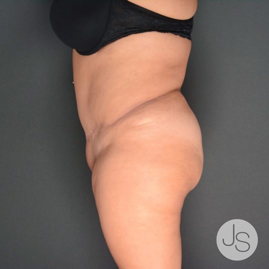 Liposuction (Smooth Lipo) Before and After Pictures Beverly Hills, CA