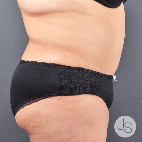 Liposuction (Smooth Lipo) Before and After Pictures Beverly Hills, CA