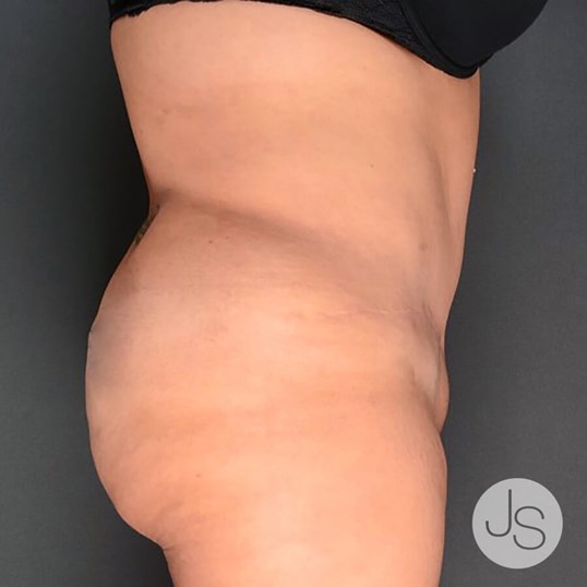 Liposuction (Smooth Lipo) Before and After Pictures Beverly Hills, CA