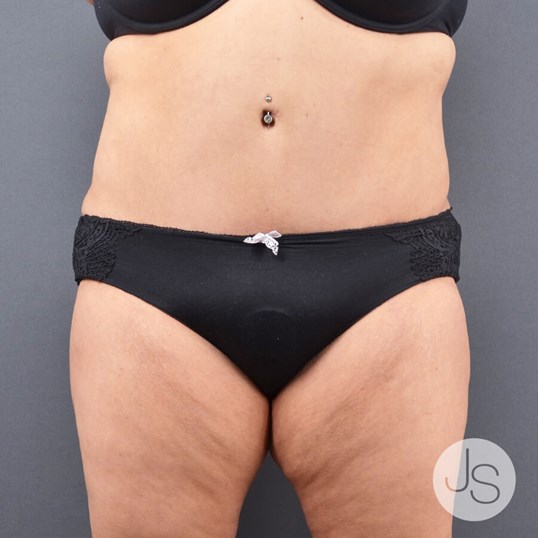 Liposuction (Smooth Lipo) Before and After Pictures Beverly Hills, CA