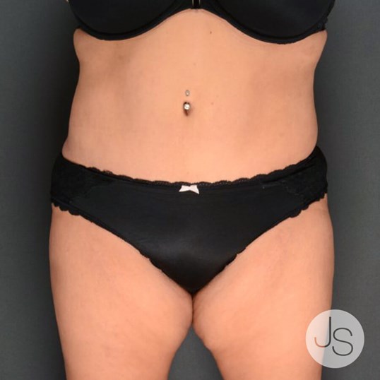 Liposuction (Smooth Lipo) Before and After Pictures Beverly Hills, CA