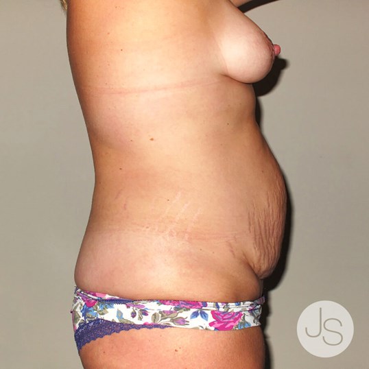 Liposuction (Smooth Lipo) Before and After Pictures Beverly Hills, CA