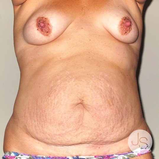 Tummy Tuck Before and After Pictures Beverly Hills, CA