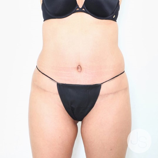 Tummy Tuck Before and After Pictures Beverly Hills, CA