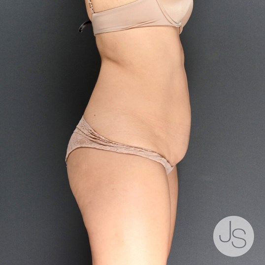 Tummy Tuck Before and After Pictures Beverly Hills, CA