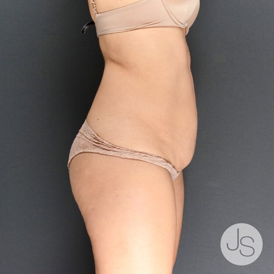 Tummy Tuck Before and After Pictures Beverly Hills, CA