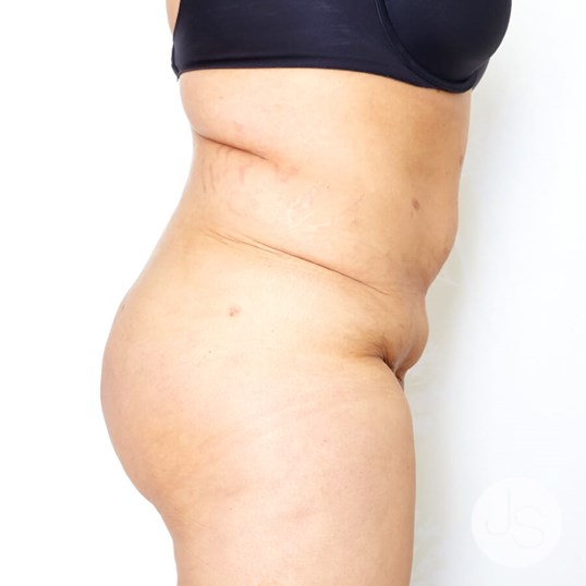 After Weight Loss Surgery Before and After Pictures Beverly Hills, CA