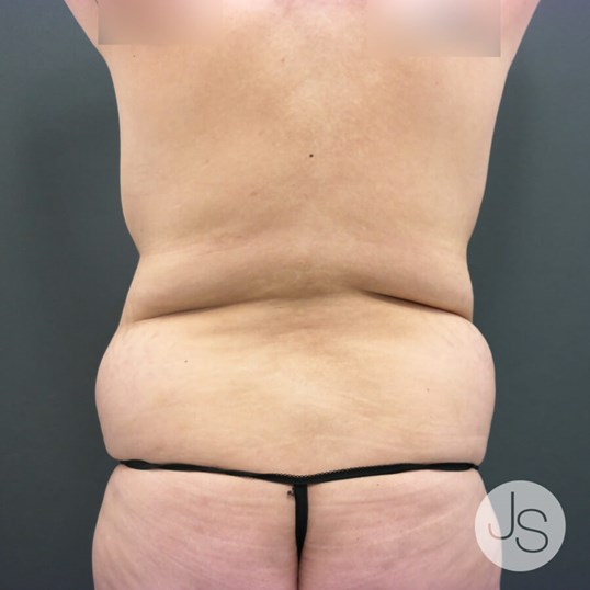 After Weight Loss Surgery Before and After Pictures Beverly Hills, CA