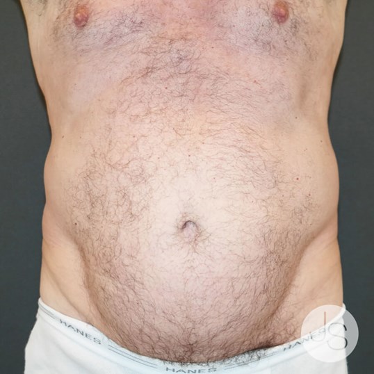 After Weight Loss Surgery Before and After Pictures Beverly Hills, CA