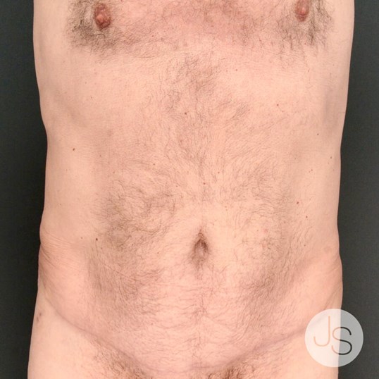 After Weight Loss Surgery Before and After Pictures Beverly Hills, CA