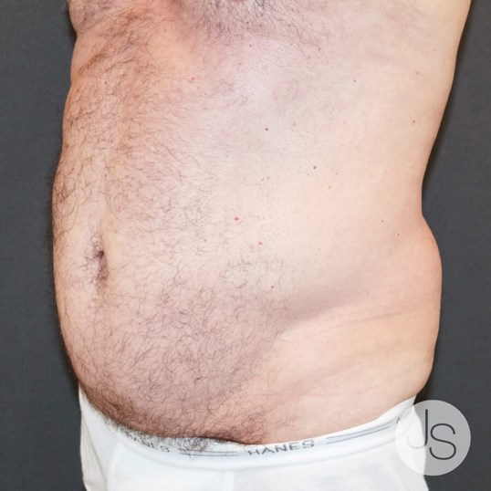 After Weight Loss Surgery Before and After Pictures Beverly Hills, CA