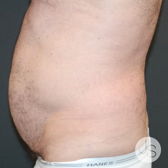 Tummy Tuck Before and After Pictures Beverly Hills, CA