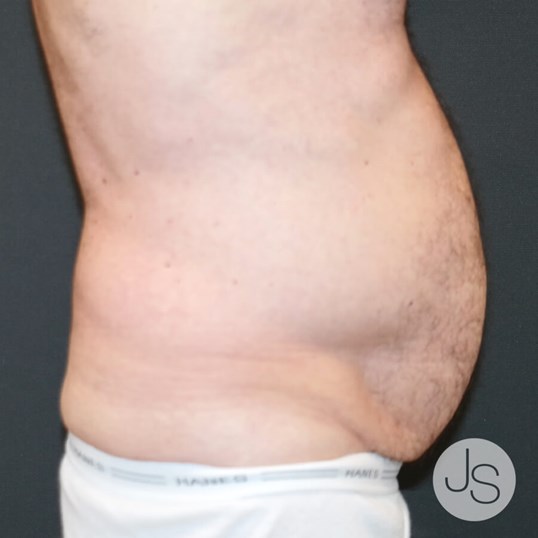 After Weight Loss Surgery Before and After Pictures Beverly Hills, CA