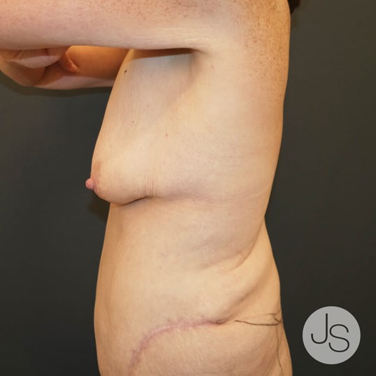 After Weight Loss Surgery Before and After Pictures Beverly Hills, CA