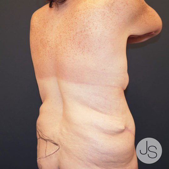 After Weight Loss Surgery Before and After Pictures Beverly Hills, CA