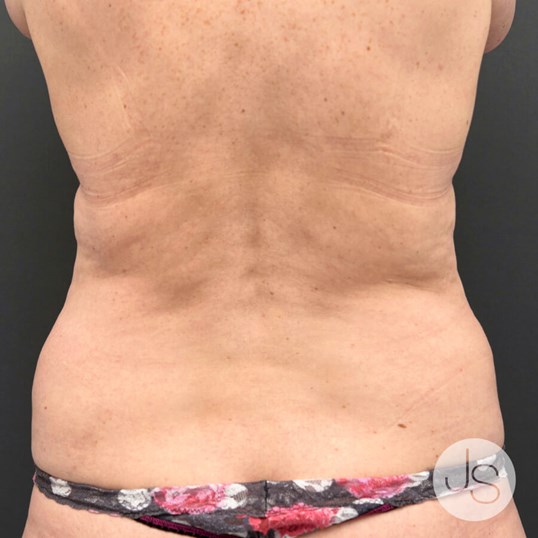 Liposuction (Smooth Lipo) Before and After Pictures Beverly Hills, CA