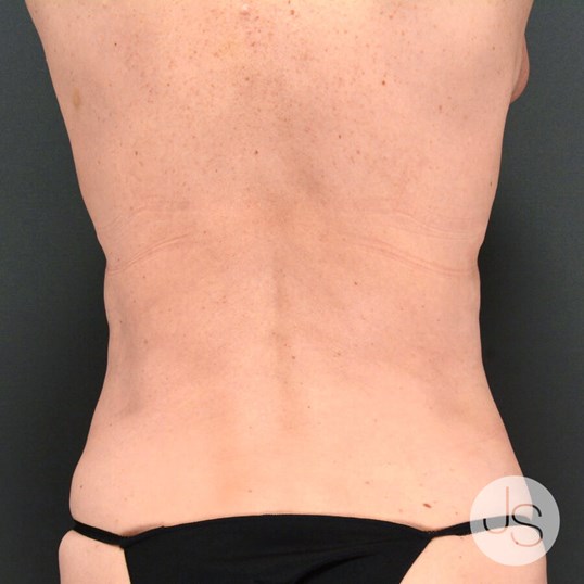 Liposuction (Smooth Lipo) Before and After Pictures Beverly Hills, CA