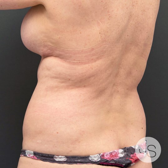 Liposuction (Smooth Lipo) Before and After Pictures Beverly Hills, CA