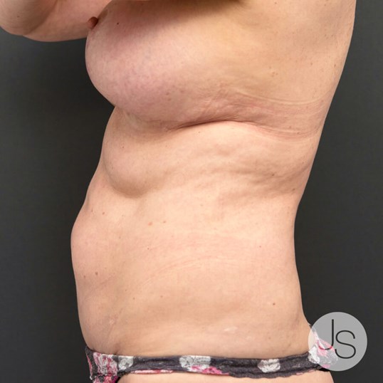 Liposuction (Smooth Lipo) Before and After Pictures Beverly Hills, CA