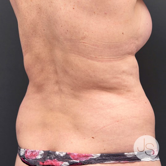 Liposuction (Smooth Lipo) Before and After Pictures Beverly Hills, CA