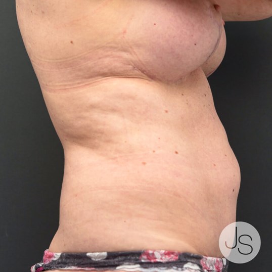 Liposuction (Smooth Lipo) Before and After Pictures Beverly Hills, CA