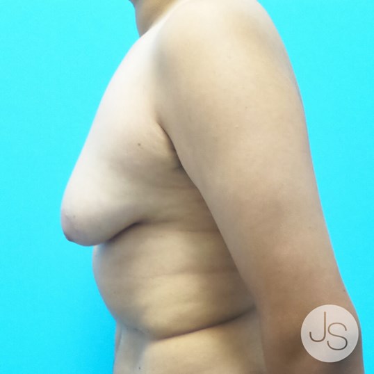 Liposuction (Smooth Lipo) Before and After Pictures Beverly Hills, CA