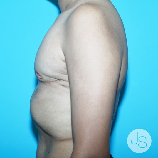 Liposuction (Smooth Lipo) Before and After Pictures Beverly Hills, CA