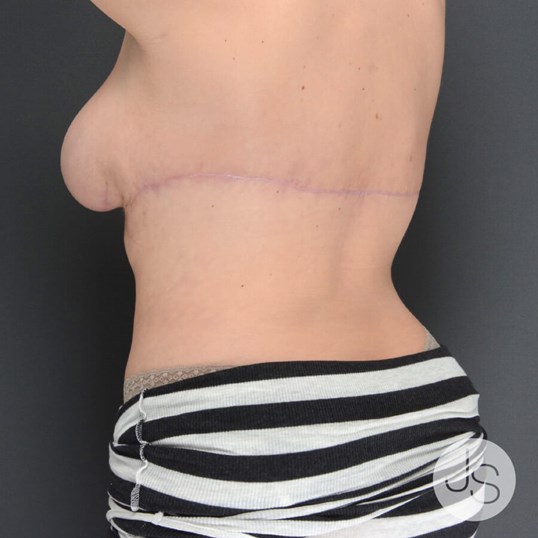 After Weight Loss Surgery Before and After Pictures Beverly Hills, CA