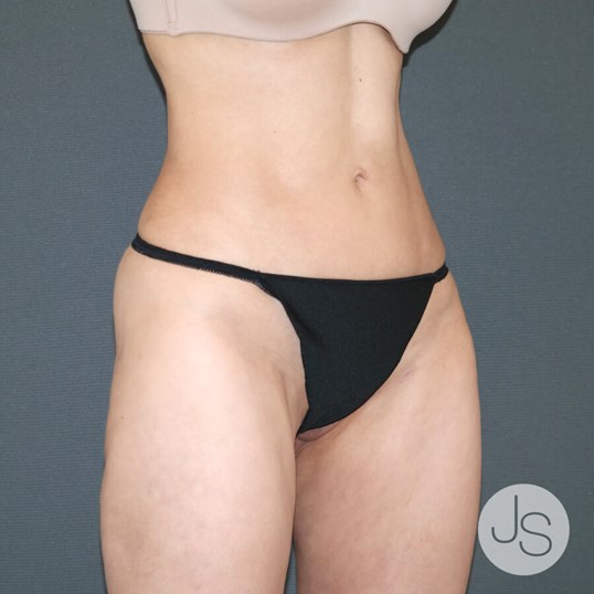 Liposuction (Smooth Lipo) Before and After Pictures Beverly Hills, CA