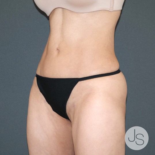 Liposuction (Smooth Lipo) Before and After Pictures Beverly Hills, CA