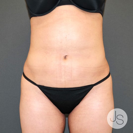 Liposuction (Smooth Lipo) Before and After Pictures Beverly Hills, CA