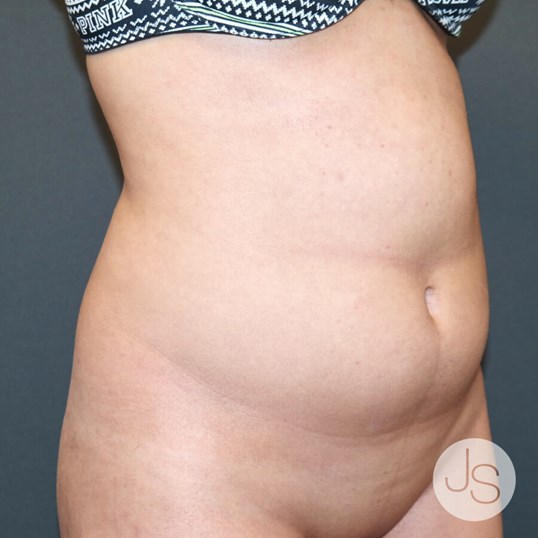 Liposuction (Smooth Lipo) Before and After Pictures Beverly Hills, CA