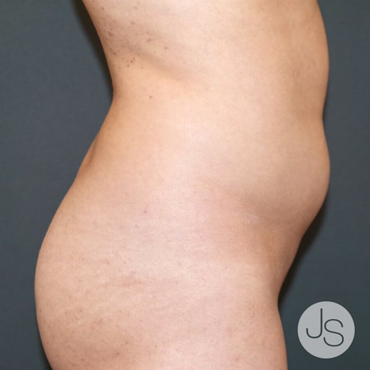 Liposuction (Smooth Lipo) Before and After Pictures Beverly Hills, CA